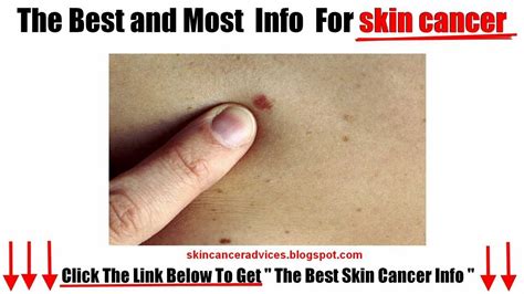 Skin Cancer Symptoms Youtube