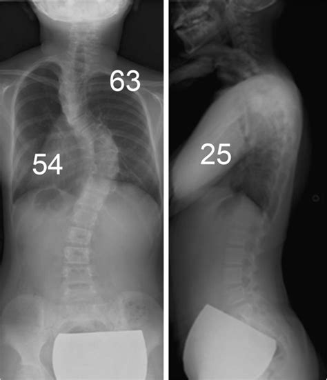 Standing X Rays Standing X Rays Show Scoliosis Of 63° At T2 7 And 54