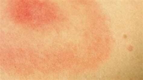 Lyme Disease Rash Pictures Test Symptoms Causes Treatment Hubpages