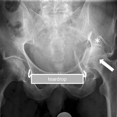 Anteroposterior Radiographs Of Different Right Hip Joints The Lateral