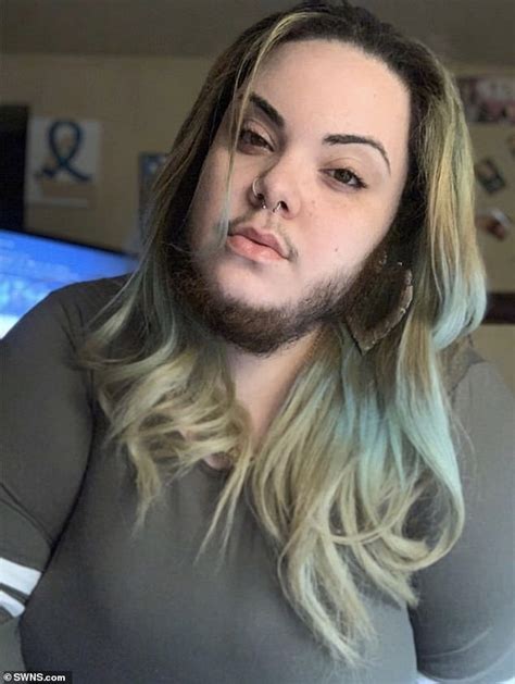 Woman 27 With Excess Facial Hair Caused By Polycystic Ovary Syndrome Decides To Grow Full