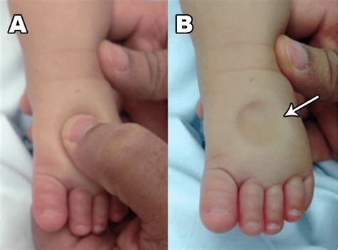 A Pitting Edema Arrow A Gentile Pressure On The Foot Dorsum And B