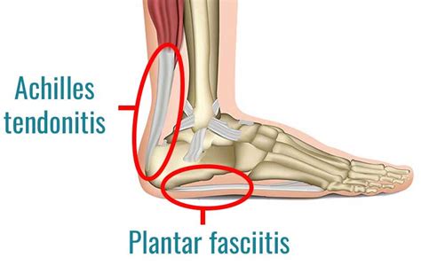 Achilles Tendonitis Vs Plantar Fasciitis How To Tell The Difference