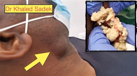 Double Trouble Jaw Cyst Dr Khaled Sadek Youtube Double Trouble