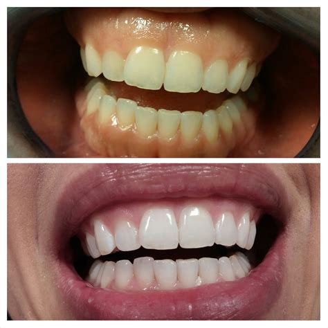 Led Laser Teeth Whitening Before And After Teeth Whitening Procedure