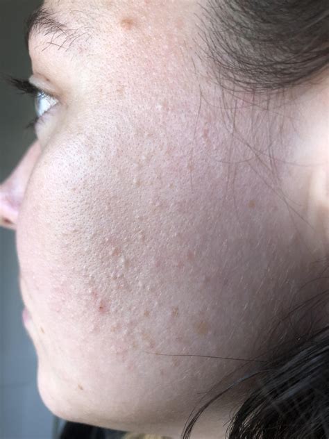 Skin Concern Looking For Help With Texture Specifically For Very