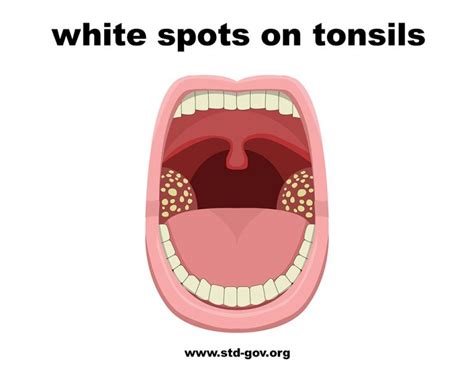 White Spots On Tonsils Causes Symptoms Treatment Pictures