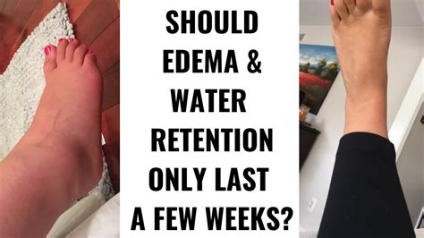 Edema Water Retention Swelling Lasting Longer Than A Year In