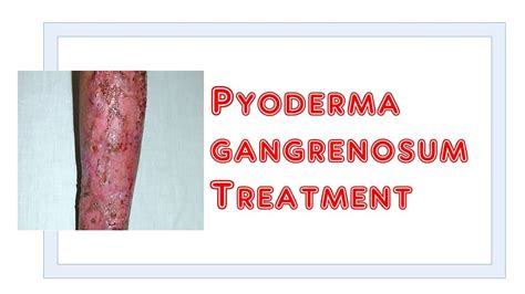 Treatment Of Pyoderma Gangrenosum Youtube