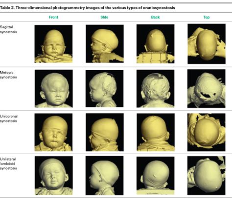 Racgp Paediatric Head Shape And Craniosynostosis