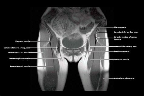 Pelvis Muscles Mri Anatomy Mri Anatomy Of Hip Joint Sexiezpicz Web Porn