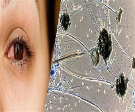 Most people will come into contact with the fungus at some point in their everyday lives. Black Fungus symptoms tissue biopsy testing is effective ...