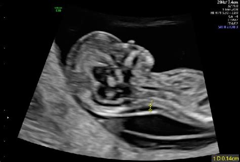 Amnion Ultrasound