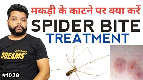 मकड़ी के काटने पर क्या करें Primary Treatment Of Spider Bite Youtube