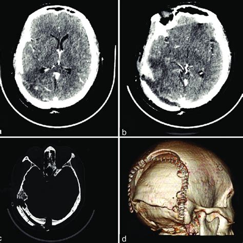 A Postoperative Contrast Cranial Computed Tomography Ct Showing