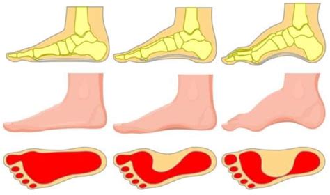 Do You Have A Bump On Top Of The Foot Hard Painful Or Bone Bump