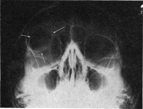 Case I X Ray Of Skull Showing Outline Of Dermoid Cyst Arrowed