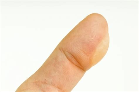 Blisters Causes Treatments And Prevention Skin Dermatitis