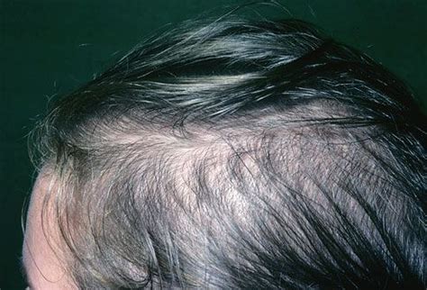 Female Pattern Baldness Hair Loss In Women May Mean Hair Thinning All