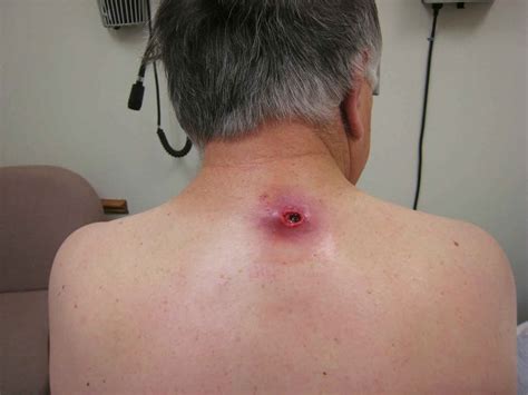 Sebaceous Cyst Causes Diagnosis And Treatment Wiki Itchy Mind Wiki