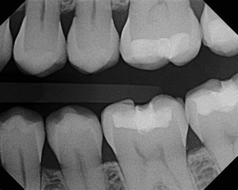 Nasal cavity is represented as a large radiolucent structure located above the maxillary incisors. Dental X-Rays: What Are They Looking for? - Philadelphia ...