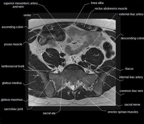 Muscles of the pelvis that cross the lumbosacral joint to attach onto the trunk were described in the previous blog post note: MRI pelvis anatomy | free male pelvis axial anatomy ...