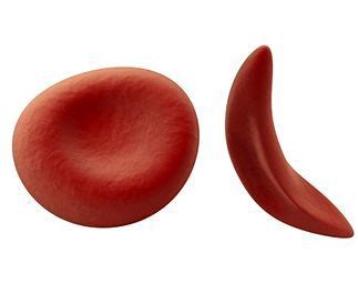 They do not catch it from some environmental source nor develop the disease later in life. Sickle Cell Anemia Symptoms