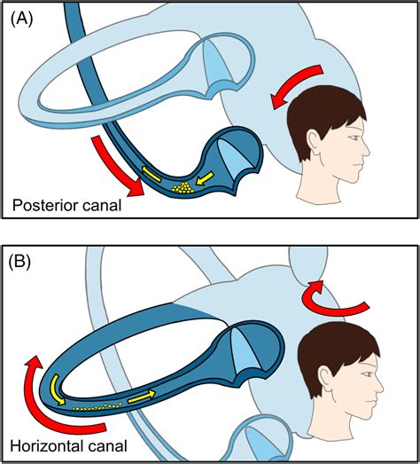 Schematic Diagram Of Endolymphatic Flow During Vhit In P‐bppv A And