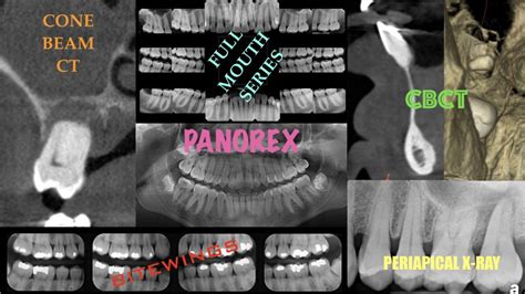 Dental X Rays Periapical Panorex Bitewing Cone Beam Ct Scan Cbct Kazemi