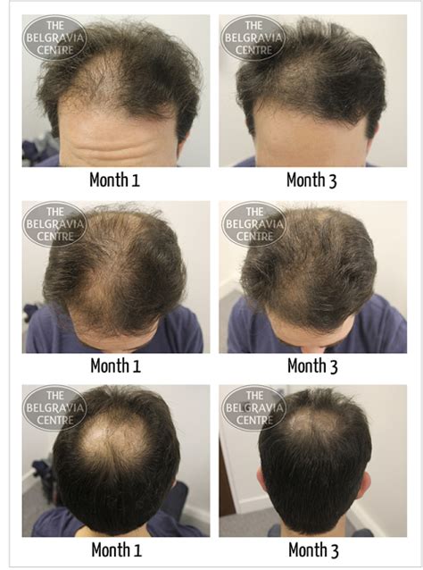How Do I Know If My Male Pattern Baldness Hair Loss Is Temporary Or