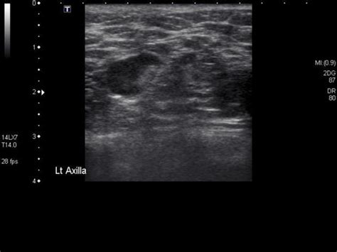 Complex Fibroadenoma Ultrasound