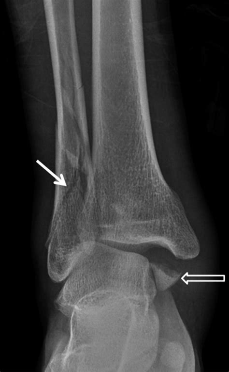 Ankle Lateral Malleolus Fracture