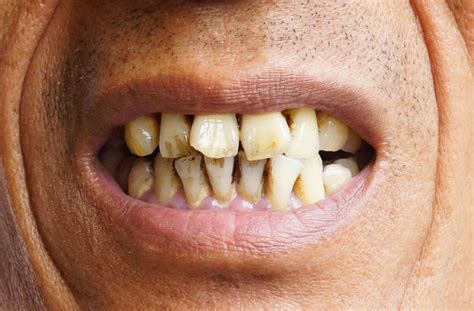 Tomorrow, a full moon in cancer heralds the beginning of a new year. Symptoms of oral cancer you should never ignore ...