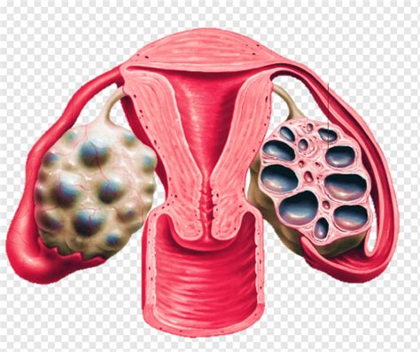 Cisto No Ovário Atrasa Menstruação