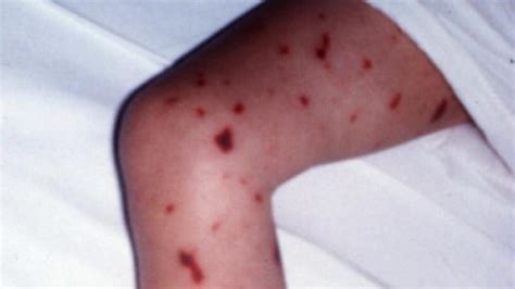 Two New Meningococcal Cases In Wa As Tally Hits 13 Perthnow