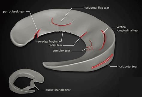 The Complete Guide To A Meniscus Tear Kinetic Labs