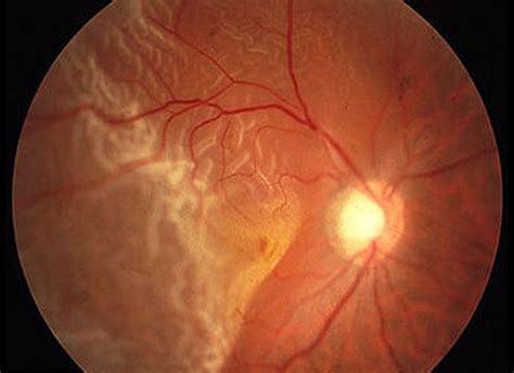 Descolamento De Retina Promácula Dr Nelson Chamma Oftalmologista