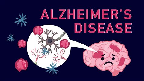What Is Alzheimer’s Disease Youtube