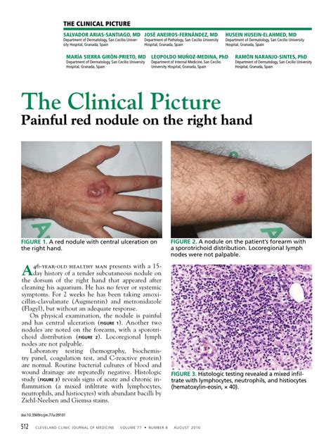 Pdf The Clinical Picture Painful Red Nodule On The Right Hand