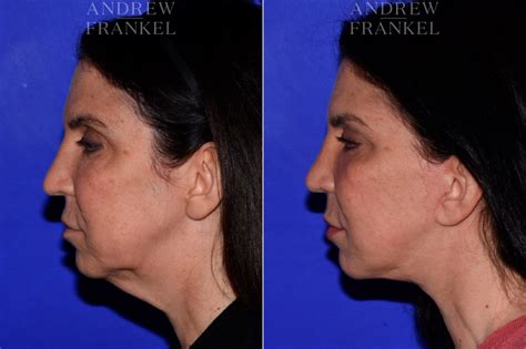 Facelift Midface Lift Photos Beverly Hills Ca Patient 16802