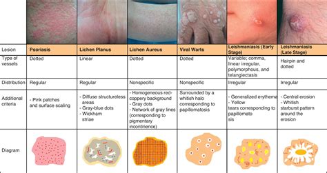 Vascular Patterns In Dermoscopy Actas Dermo Sifiliográficas English