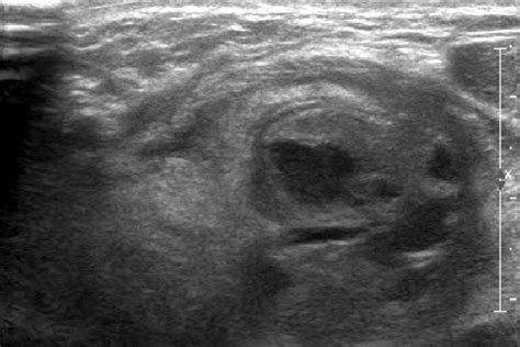 Neck Ultrasonography Probable Abscess And Phlegmonous Change In The