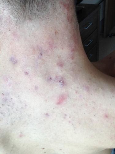 Purple Marks From Cystic Acne Back Of Neck Help Pictures Scar