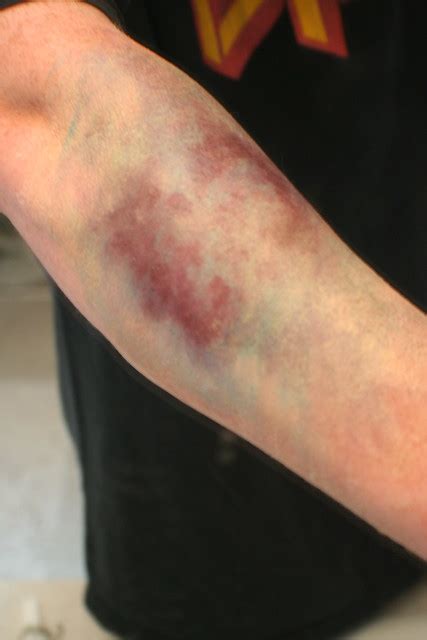 Arm Bruise Flickr Photo Sharing