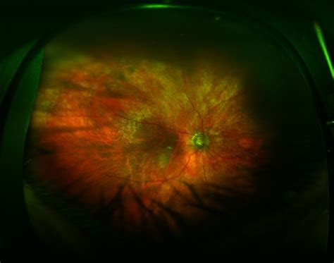 Optic Atrophy And Attenuated Retinal Vessels Following Endophthalmitis