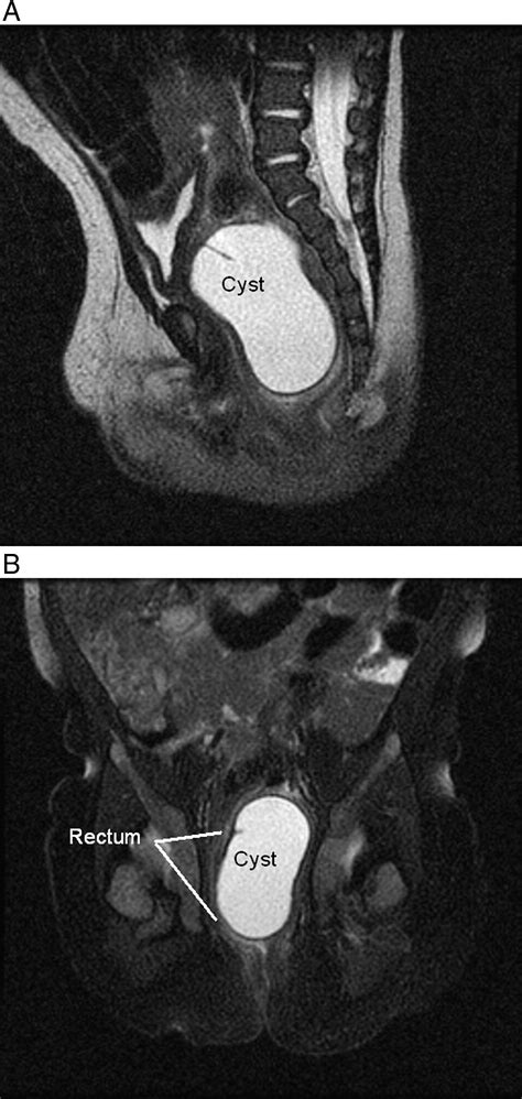 Laparoscopic Excision Of A Newborn Rectal Duplication Cyst Journal Of Pediatric Surgery