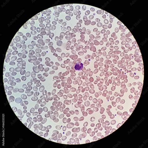 Blood Smear Under Microscope Showing Abnormal Foto Stock Hot Sex Picture