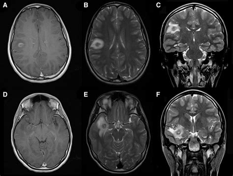 Multiple Sclerosis With Pseudotumoral Demyelinating Lesions In A Female Adolescent Presenting