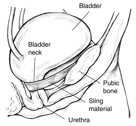 sling operation for stress incontinence - Google Search ...