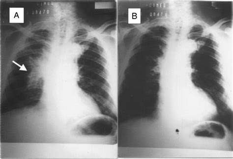 There are four different stages, among which stage 4 is the most harmful stage, which cannot be reversed. Chest X-ray of a stage IV non-small-cell lung cancer ...